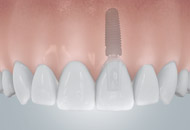 single-tooth restorations