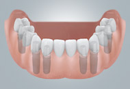 restoring several teeth
